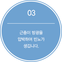 3.근종이 방광을압박하여 빈뇨가 생깁니다.